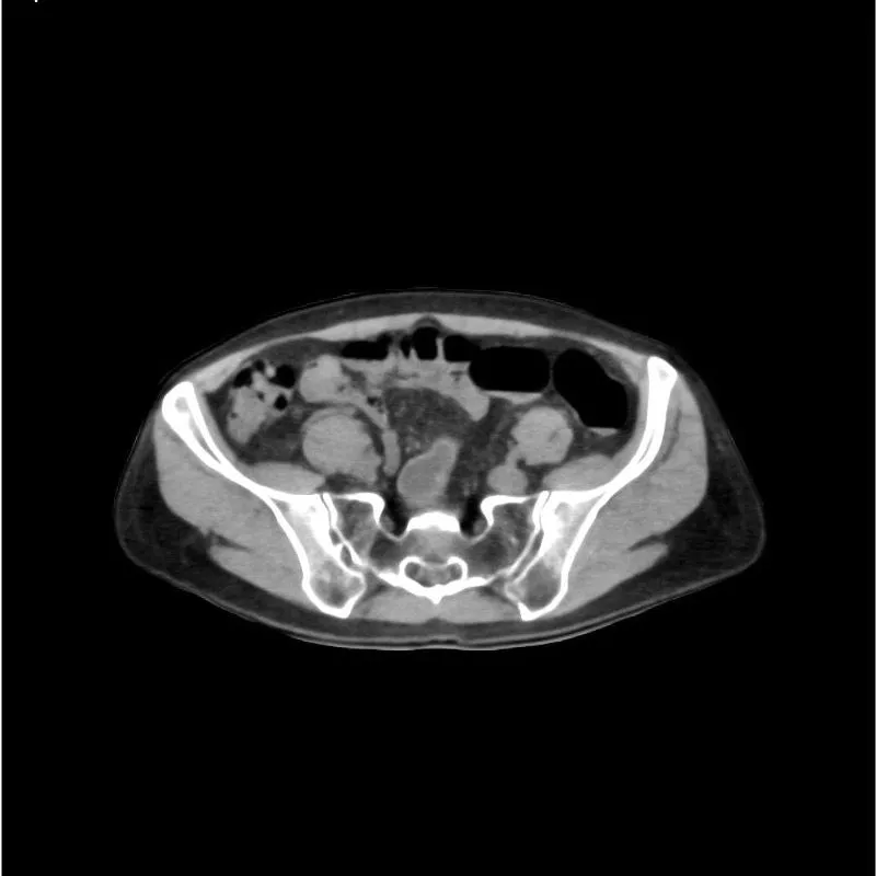 Abdomen and Pelvis Phantom - Native