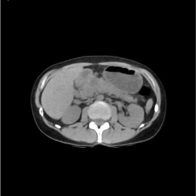 Abdomen and Pelvis Phantom - Native