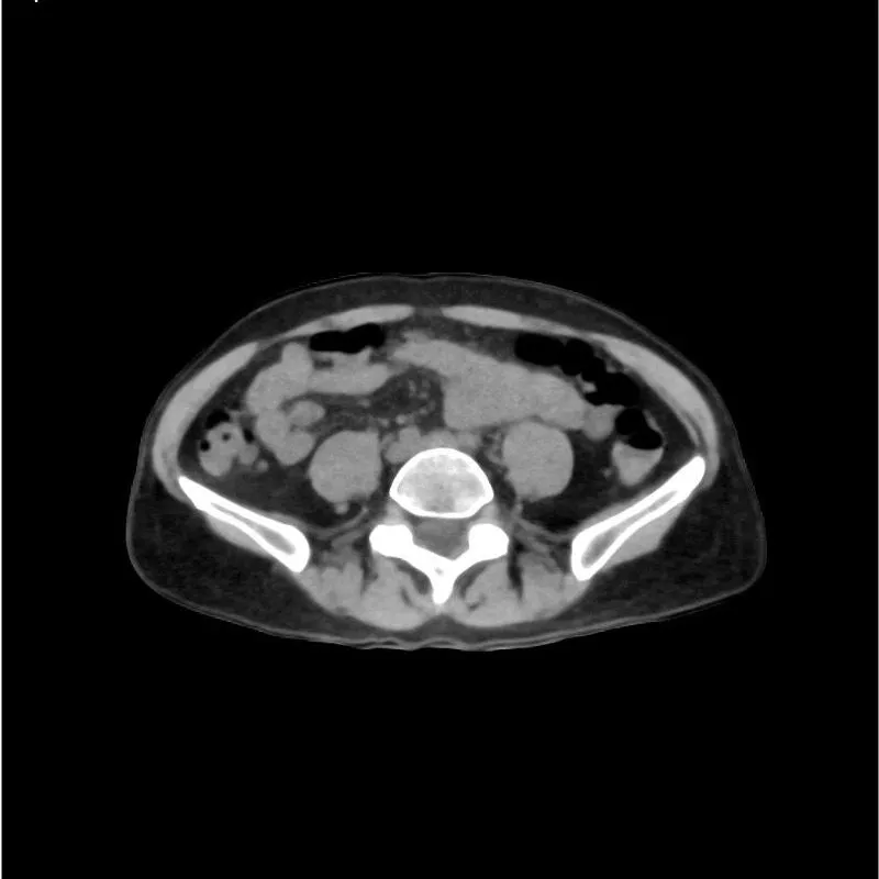 Abdomen and Pelvis Phantom - Native