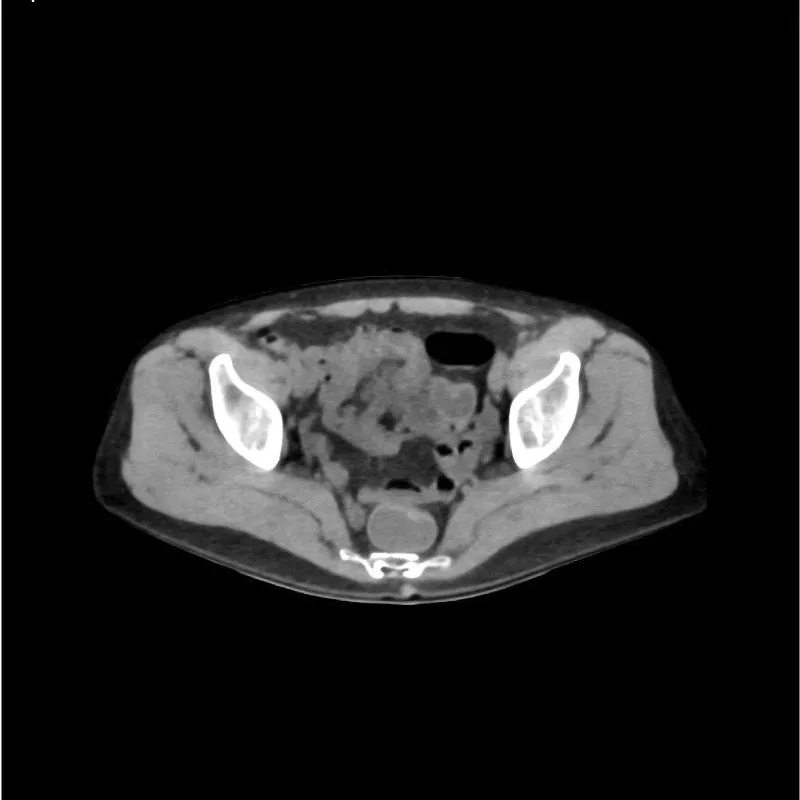 Abdomen and Pelvis Phantom - Native