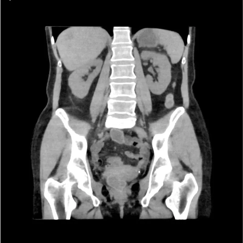 Abdomen and Pelvis Phantom - Native