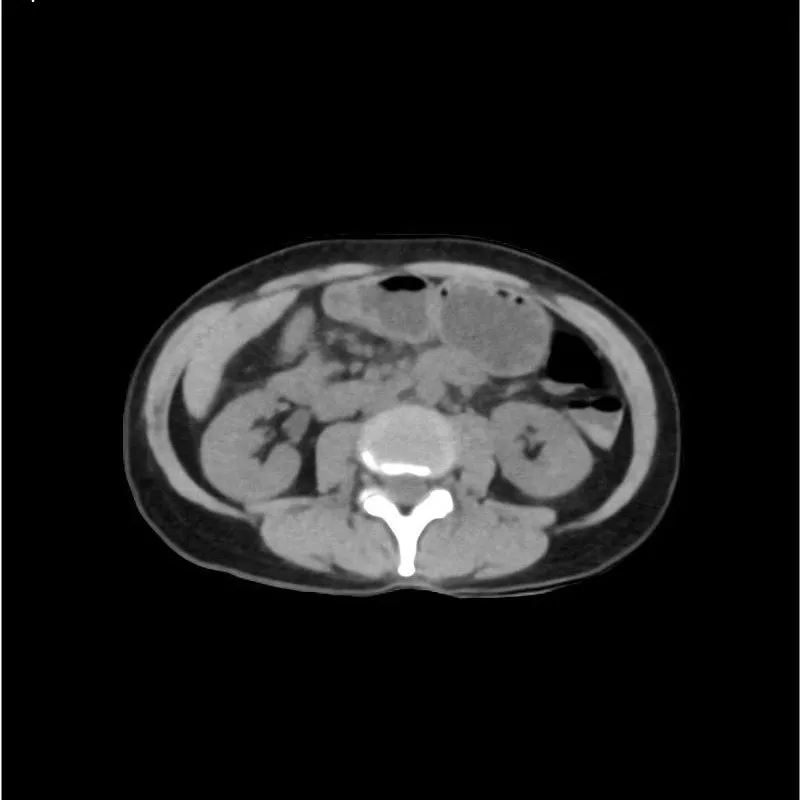 Abdomen and Pelvis Phantom - Native