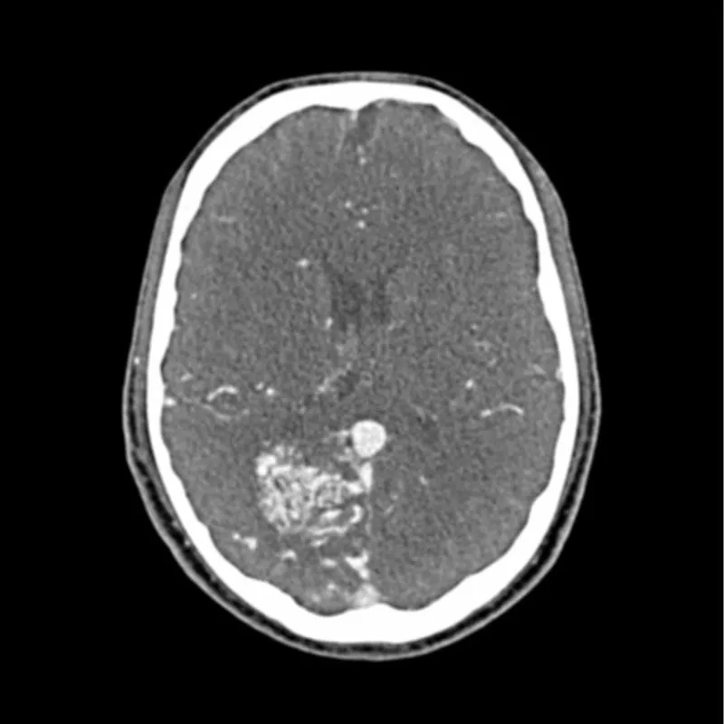 Head and Neck CTA Phantom AVM