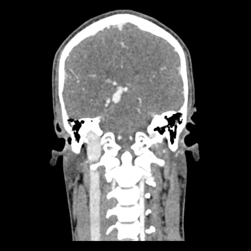 Head and Neck CTA Phantom AVM