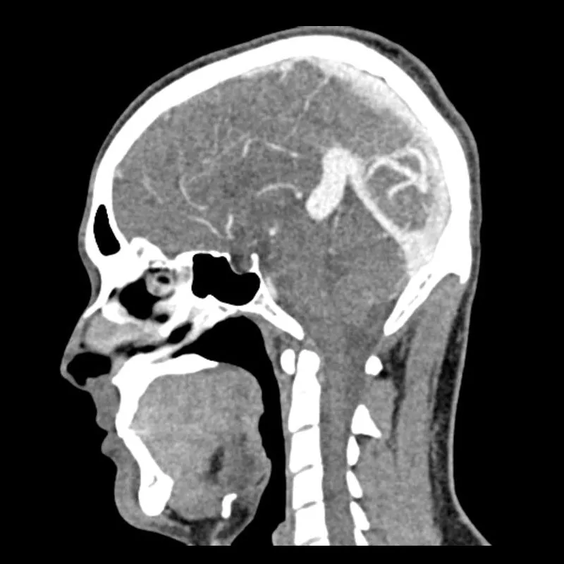 Head and Neck CTA Phantom AVM