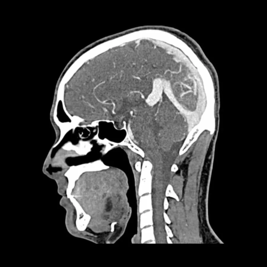 Head and Neck CTA Phantom AVM