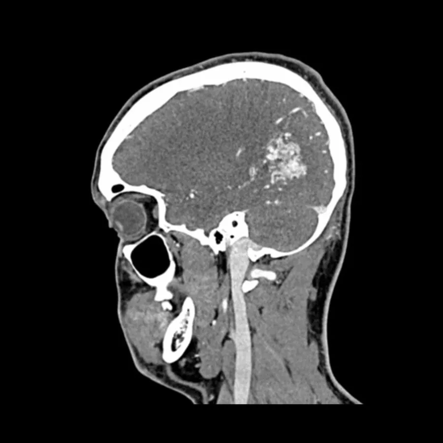 Head and Neck CTA Phantom AVM