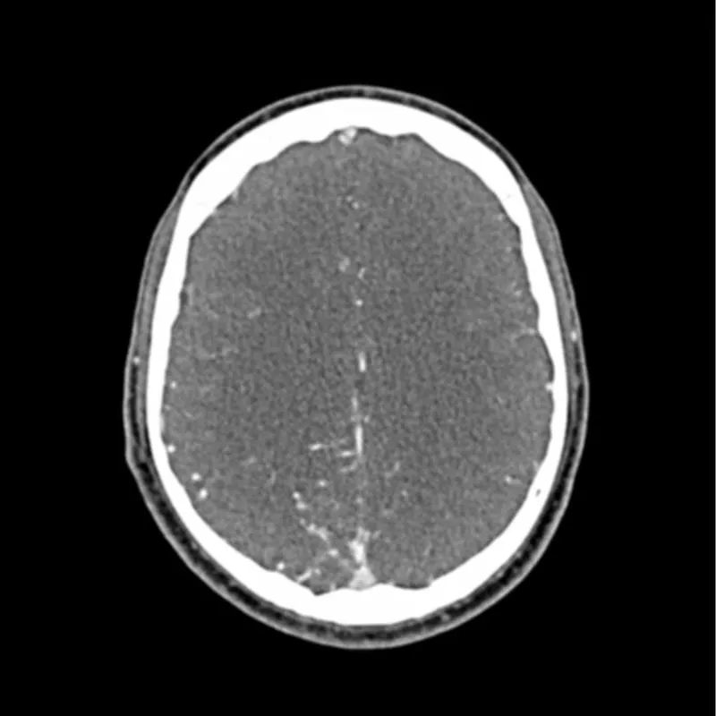 Head and Neck CTA Phantom AVM