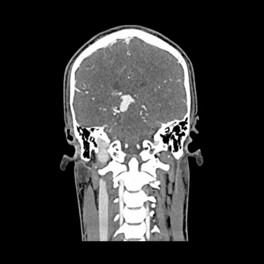 Head and Neck CTA Phantom AVM