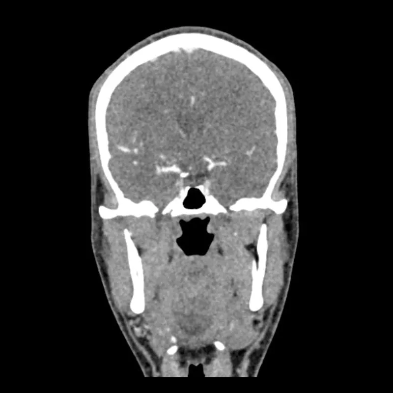 Head and Neck CTA Phantom AVM