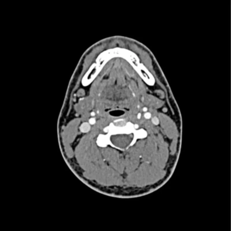 Head and Neck CTA Phantom AVM