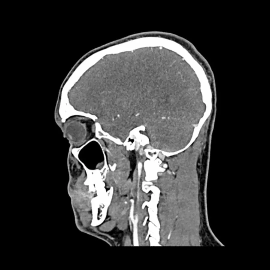 Head and Neck CTA Phantom AVM