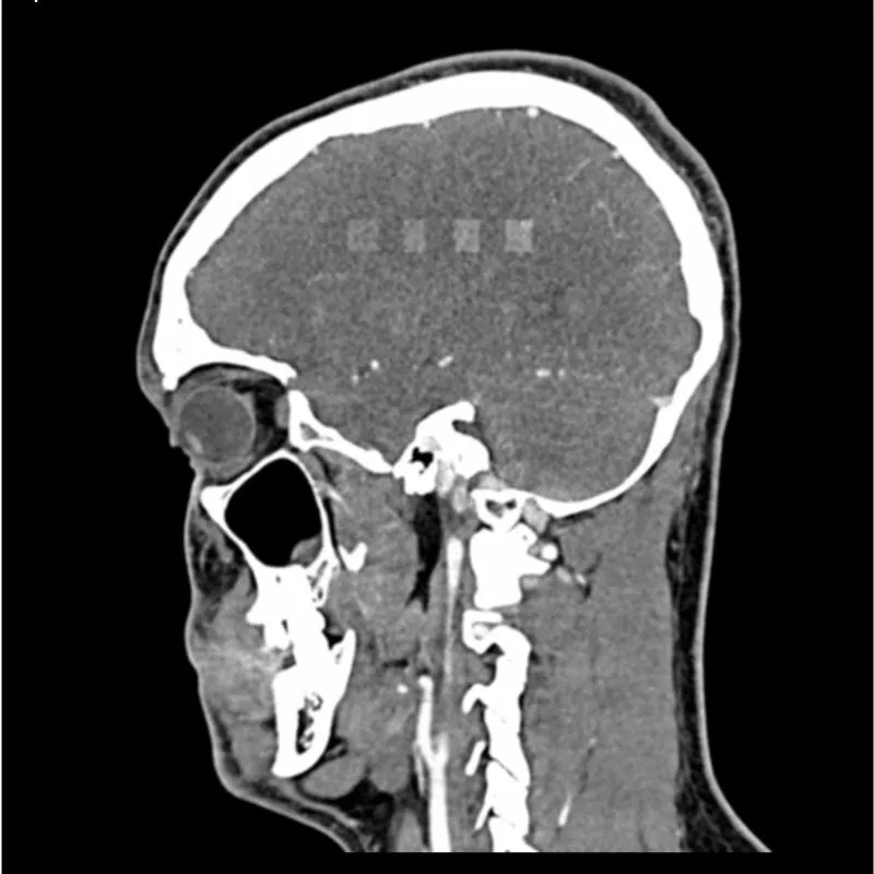 Head and Neck Phantom - CTA AVM / lesion
