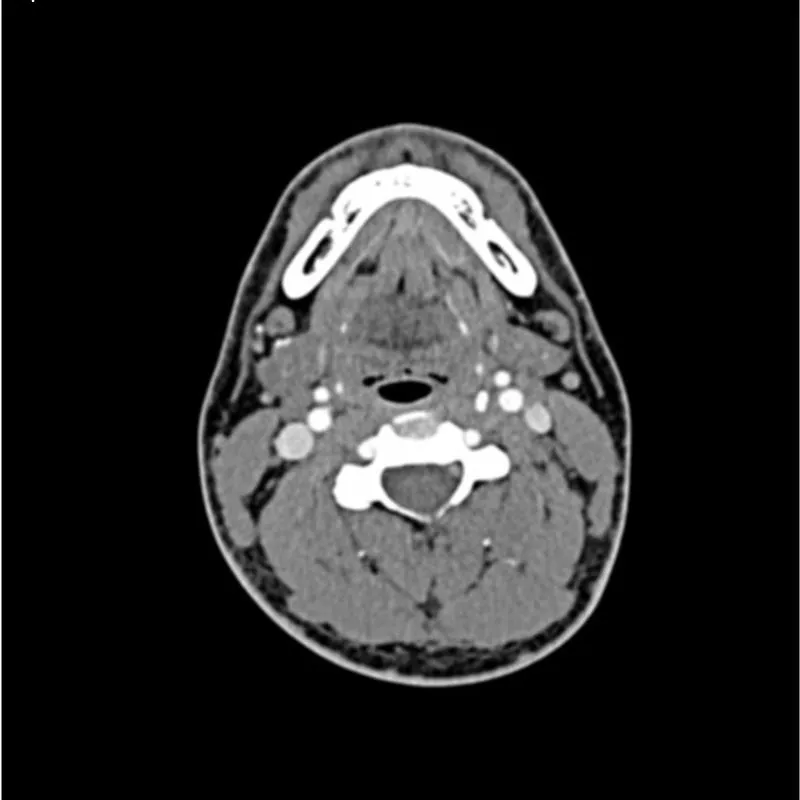 Head and Neck Phantom - CTA AVM / lesion