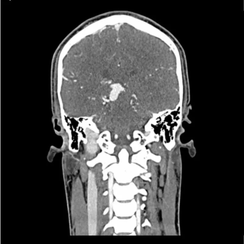 Head and Neck Phantom - CTA AVM / lesion