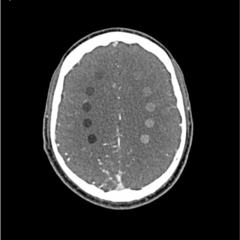 Head and Neck Phantom - CTA AVM / lesion
