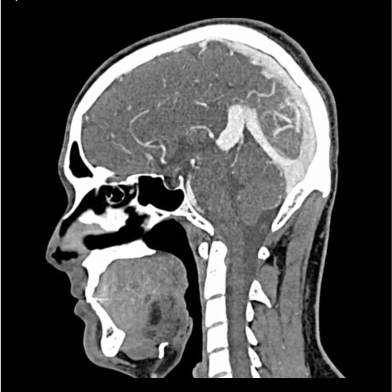 Head and Neck Phantom - CTA AVM / lesion