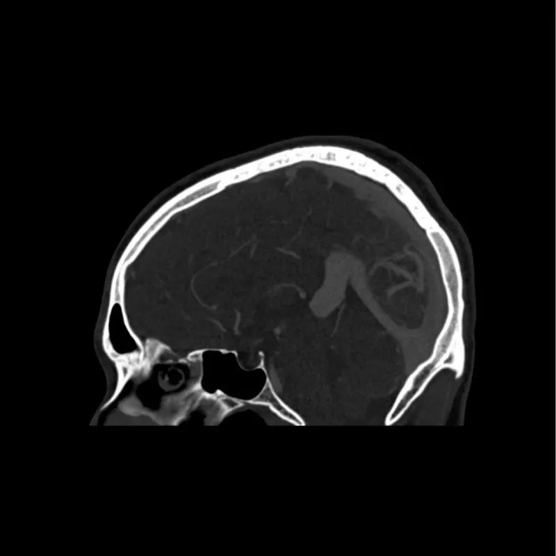 Head Phantom - CTA AVM