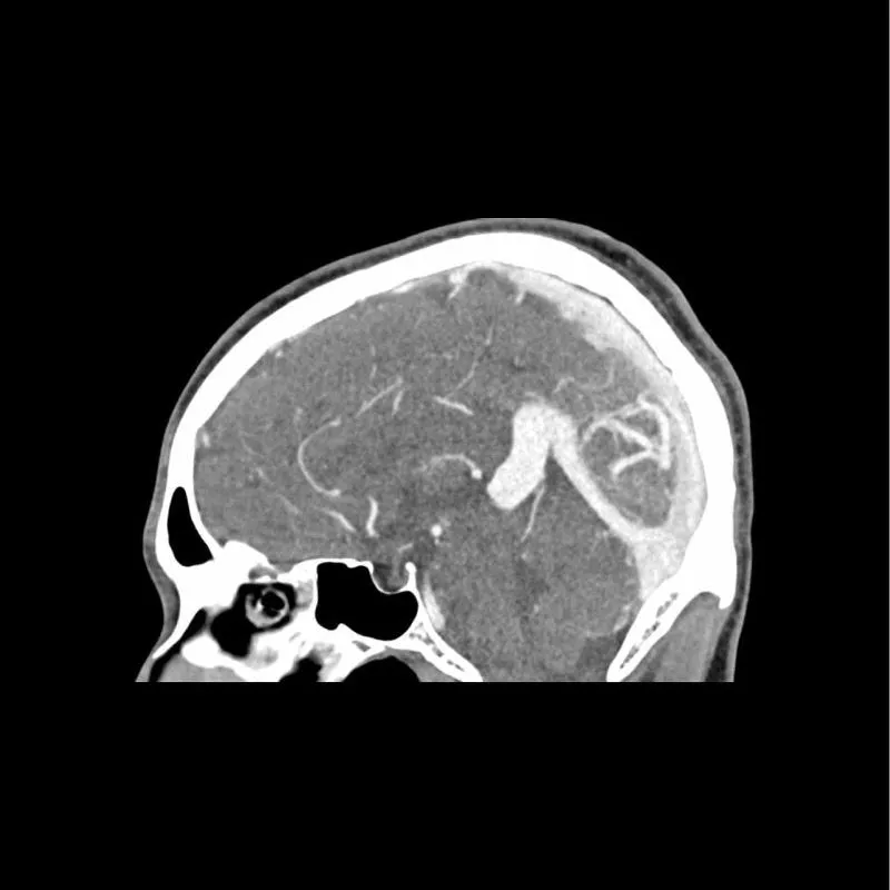 Head Phantom - CTA AVM
