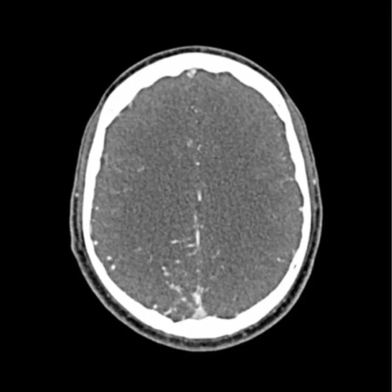 Head Phantom - CTA AVM