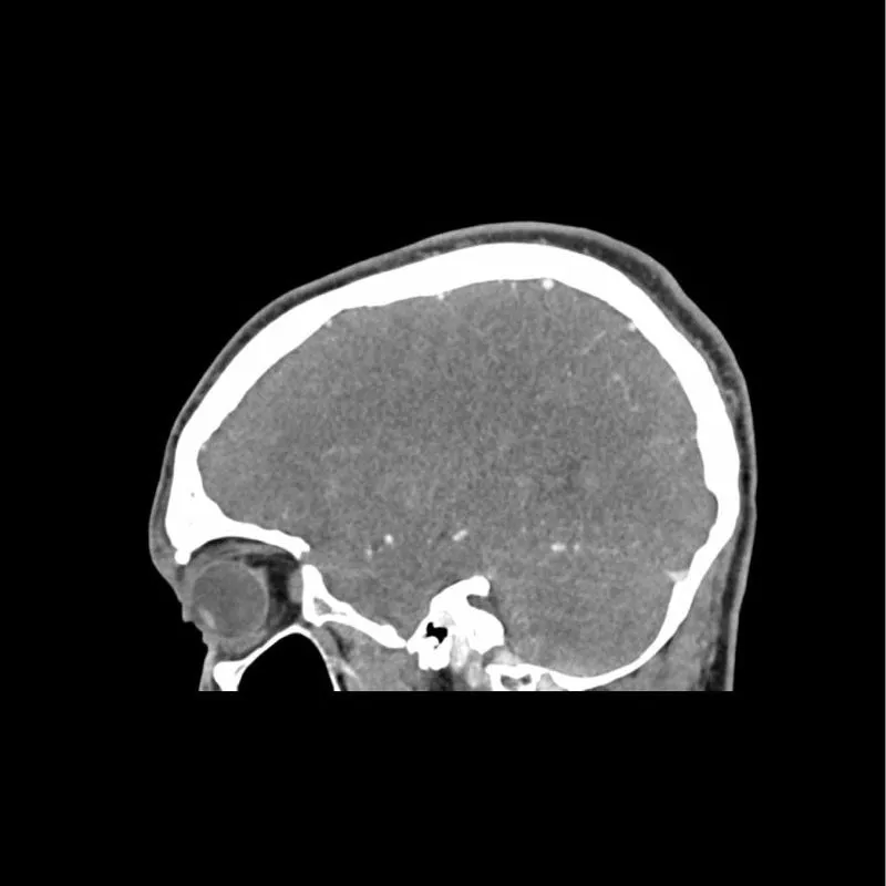 Head Phantom - CTA AVM