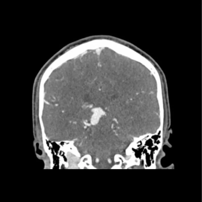 Head Phantom - CTA AVM