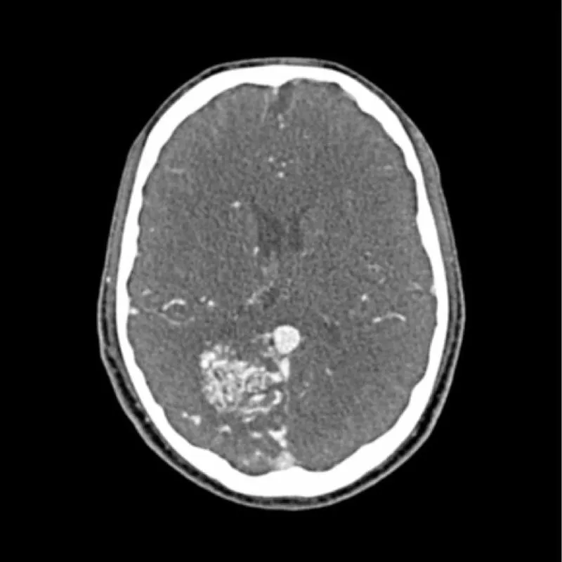 Head Phantom - CTA AVM