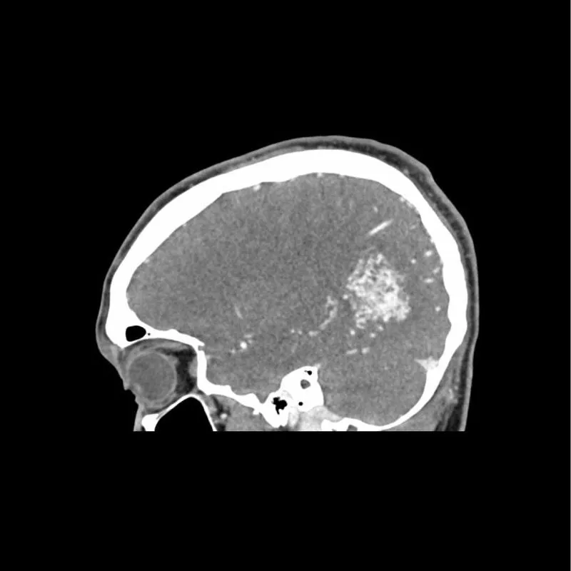 Head Phantom - CTA AVM