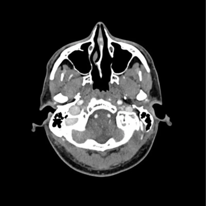 Head Phantom - CTA AVM