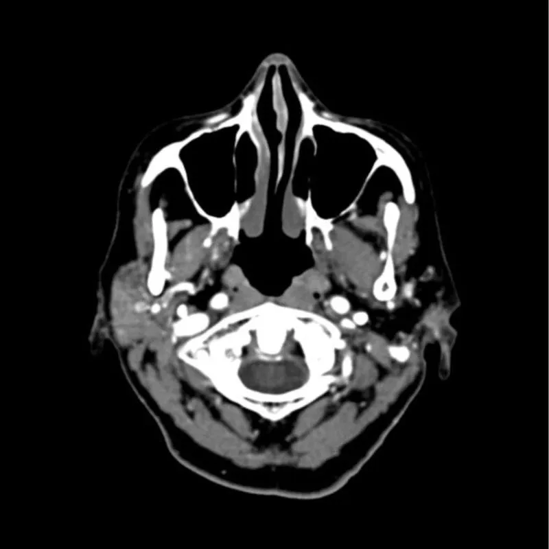Head Phantom - CTA